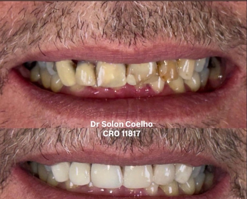 Antes e depois — tratamento estético Dr. Solon Coelho