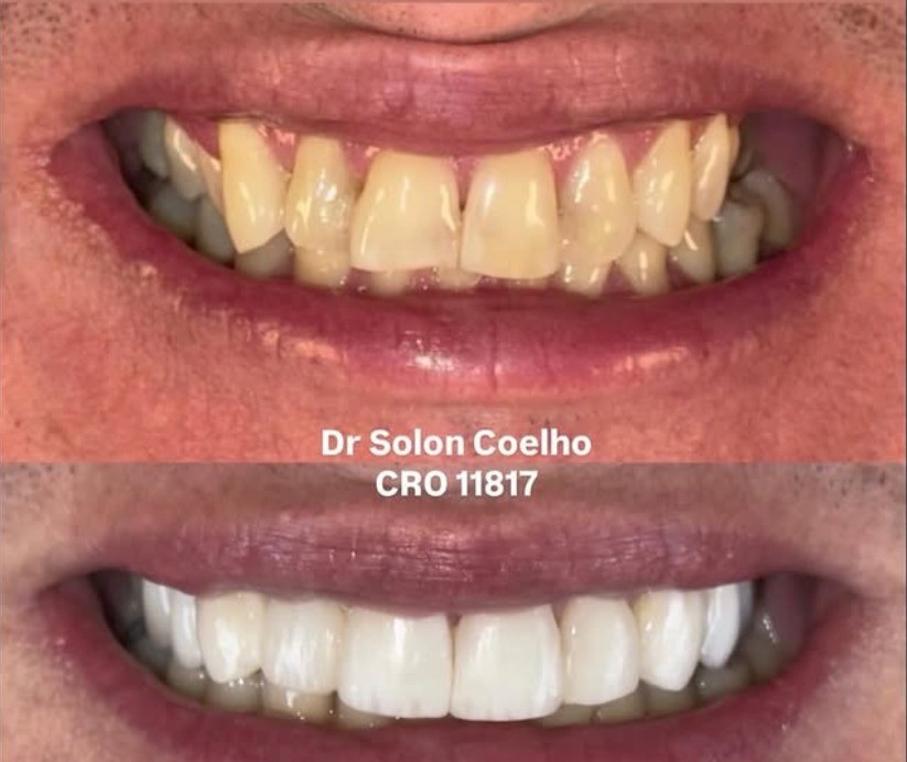 Antes e depois — tratamento estético Dr. Solon Coelho